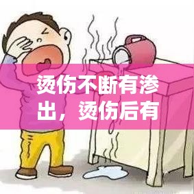 烫伤不断有渗出,烫伤后有渗出